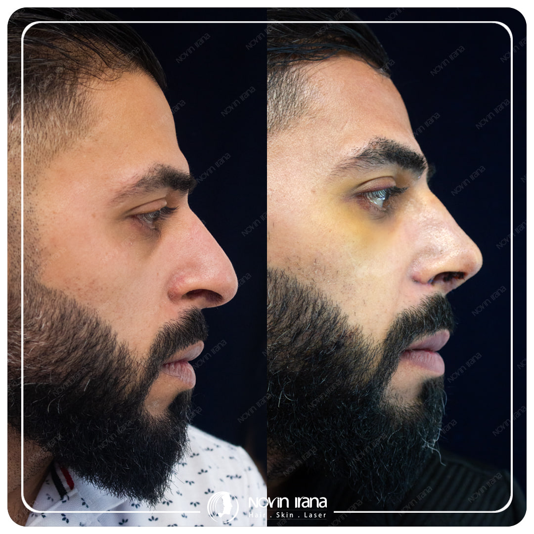 Rhinoplasty