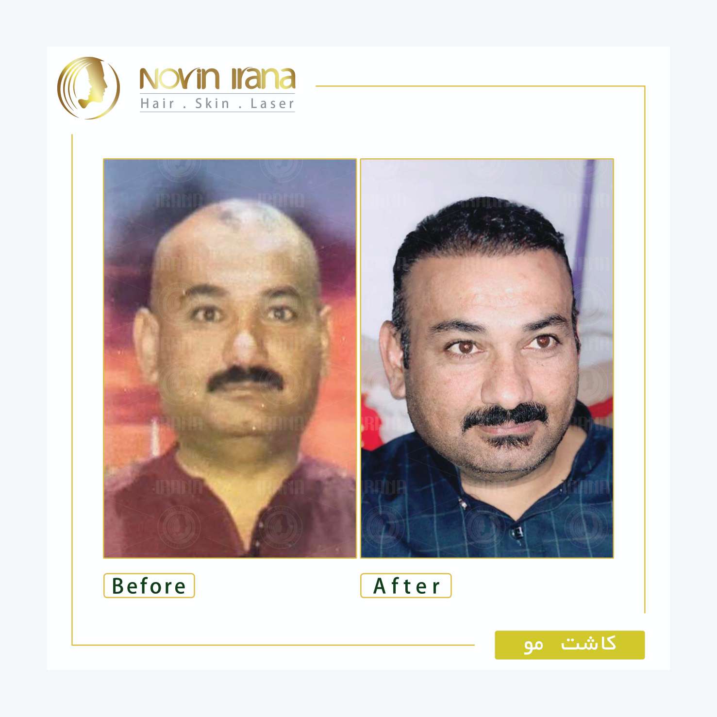 نمونه کاشت مو