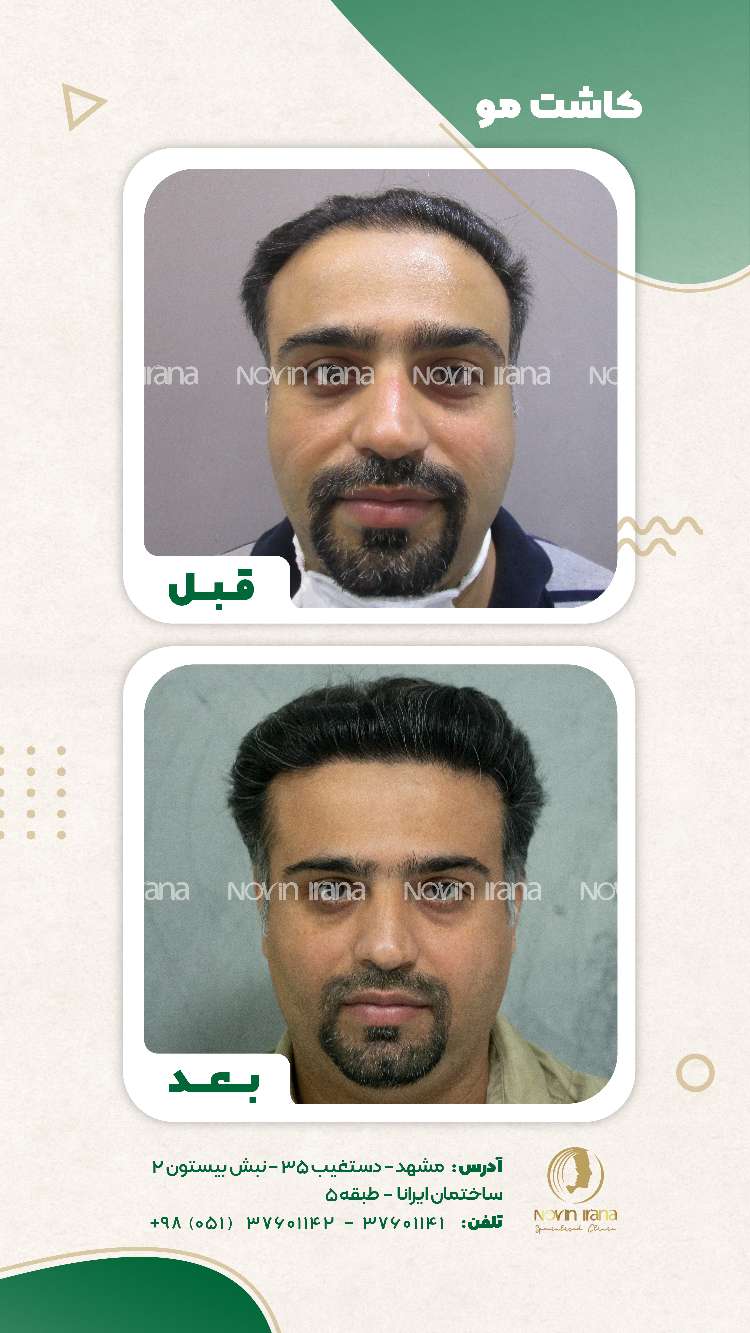 نمونه کاشت مو