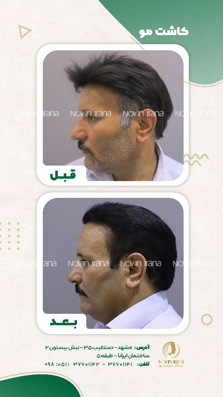 نمونه کاشت مو