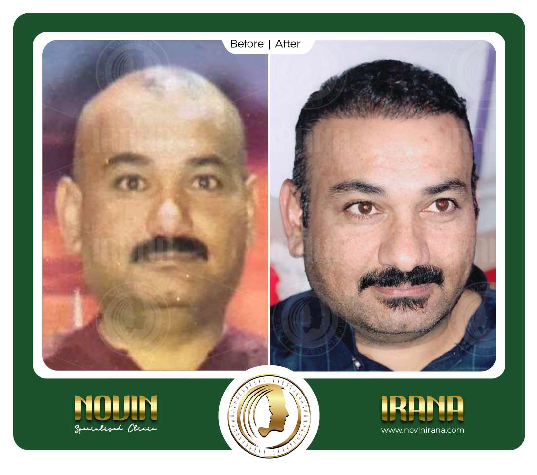 نمونه کاشت مو