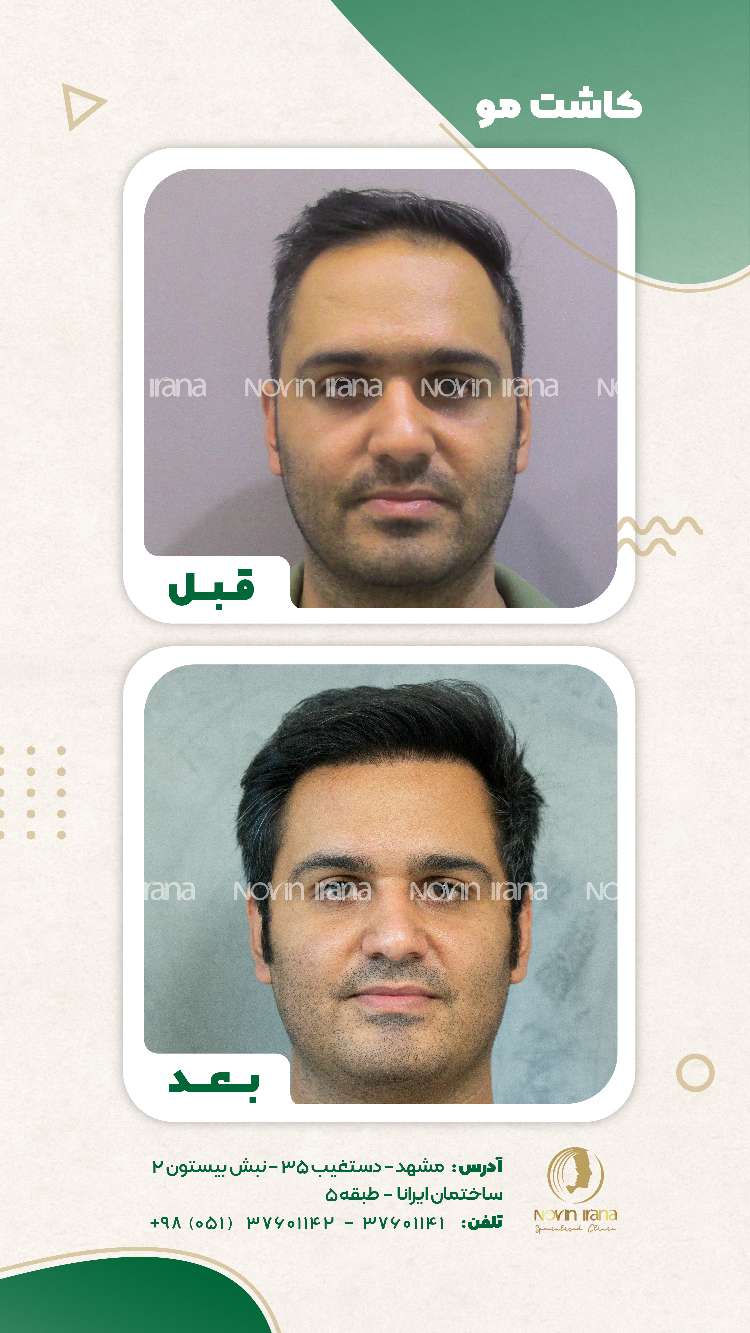 نمونه کاشت مو