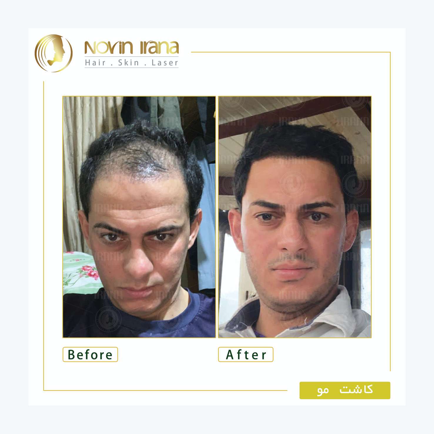 نمونه کاشت مو