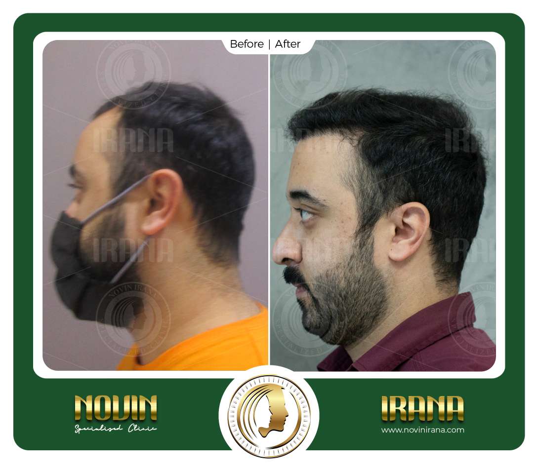 نمونه کاشت مو
