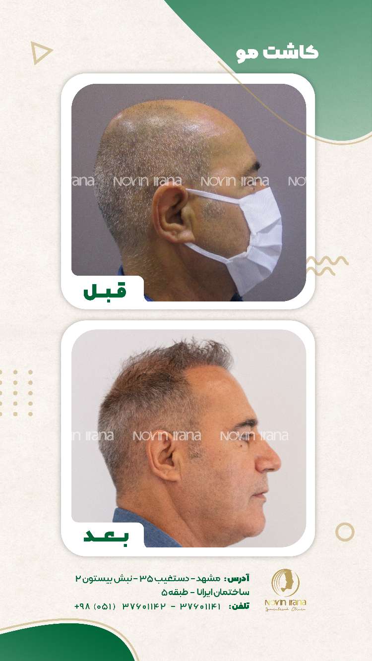 نمونه کاشت مو