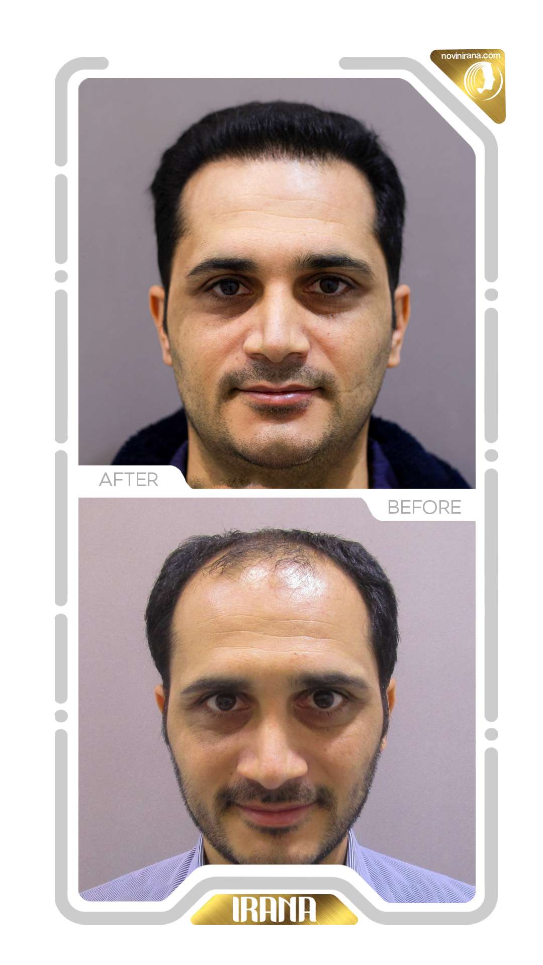 نمونه کاشت مو