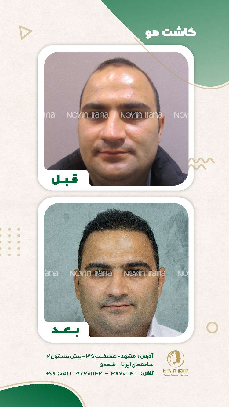 نمونه کاشت مو