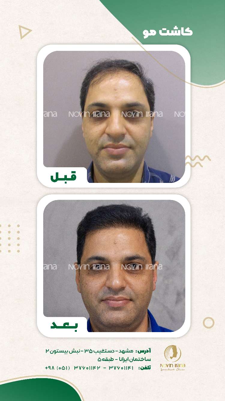 نمونه کاشت مو