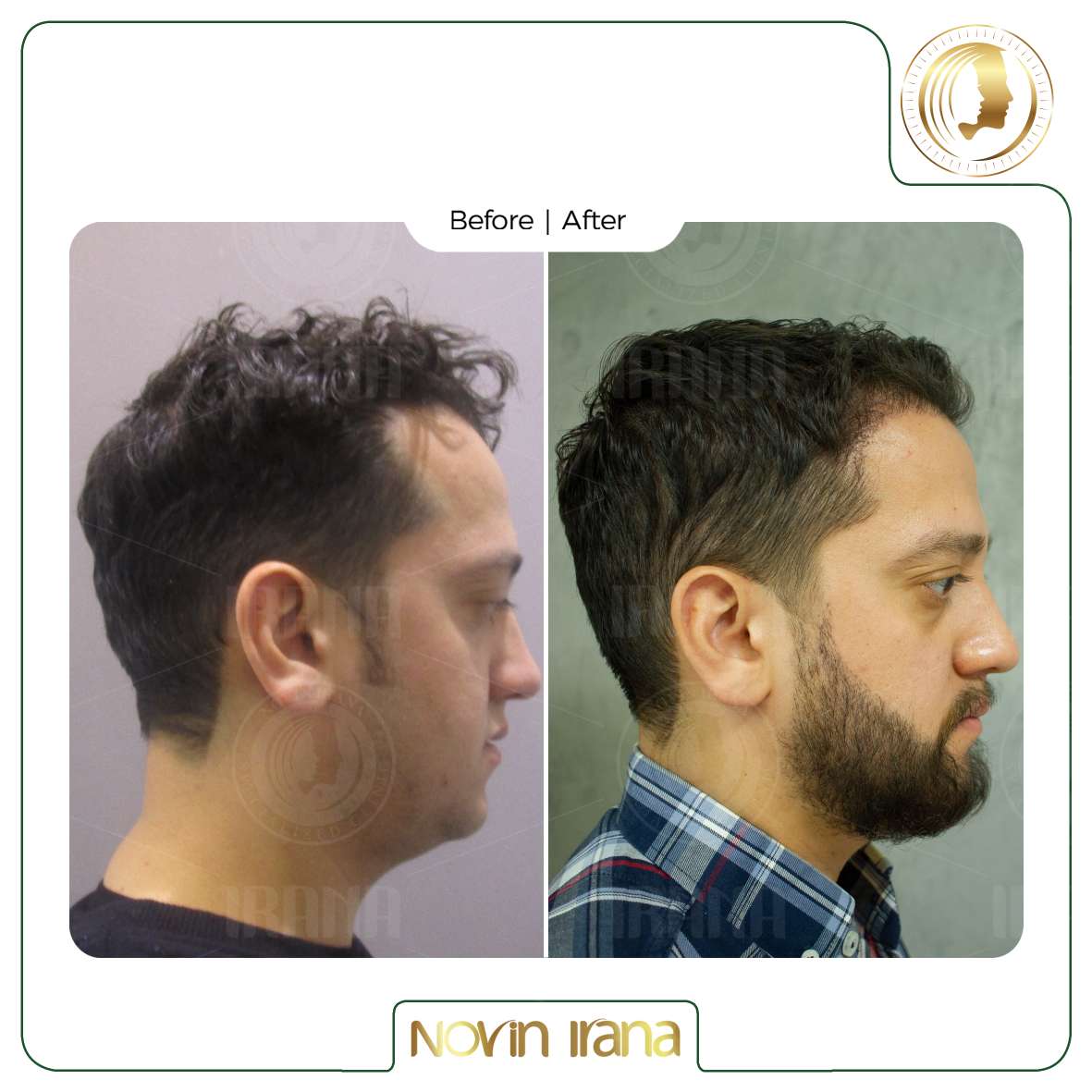 نمونه کاشت مو