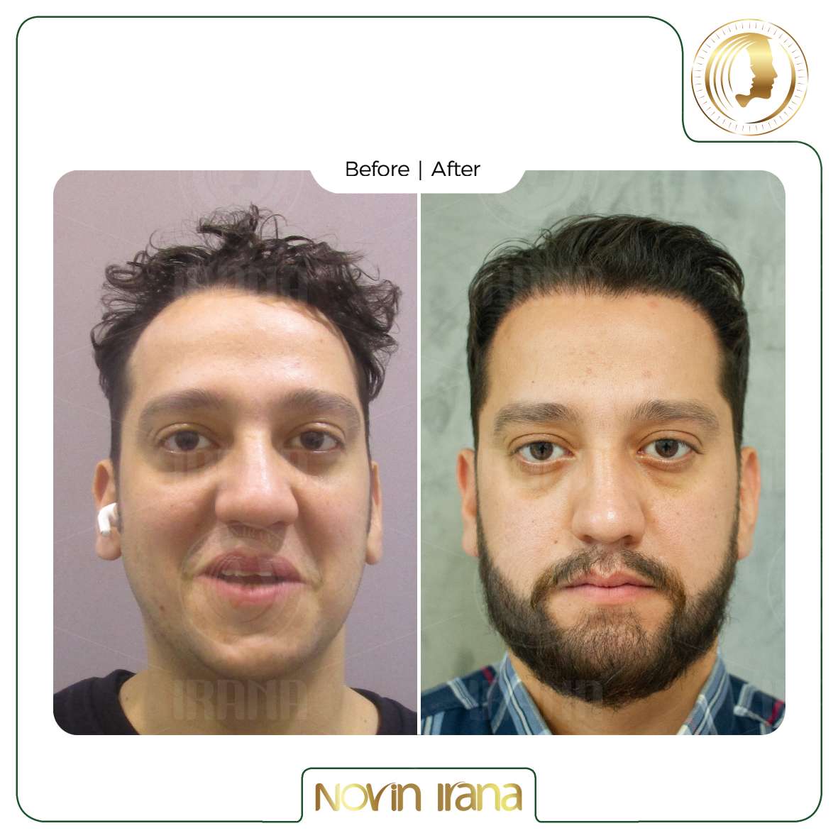 نمونه کاشت مو