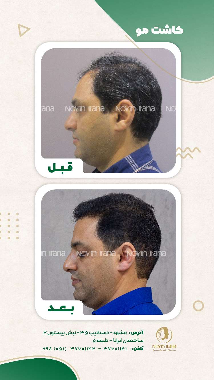 نمونه کاشت مو