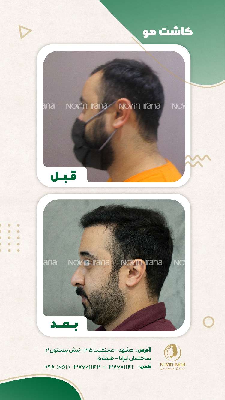 نمونه کاشت مو