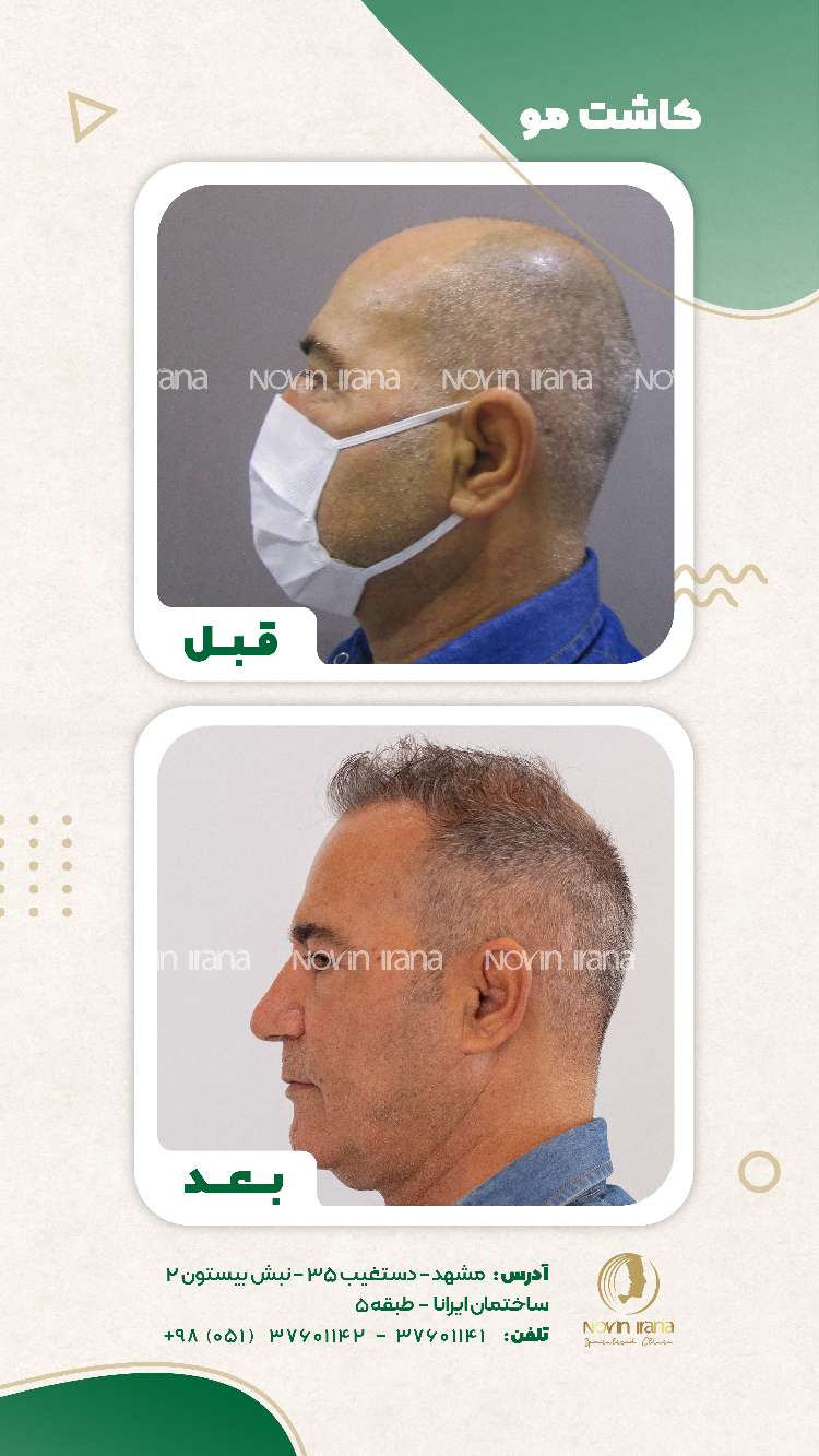 نمونه کاشت مو