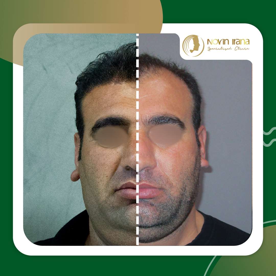 نمونه کاشت مو