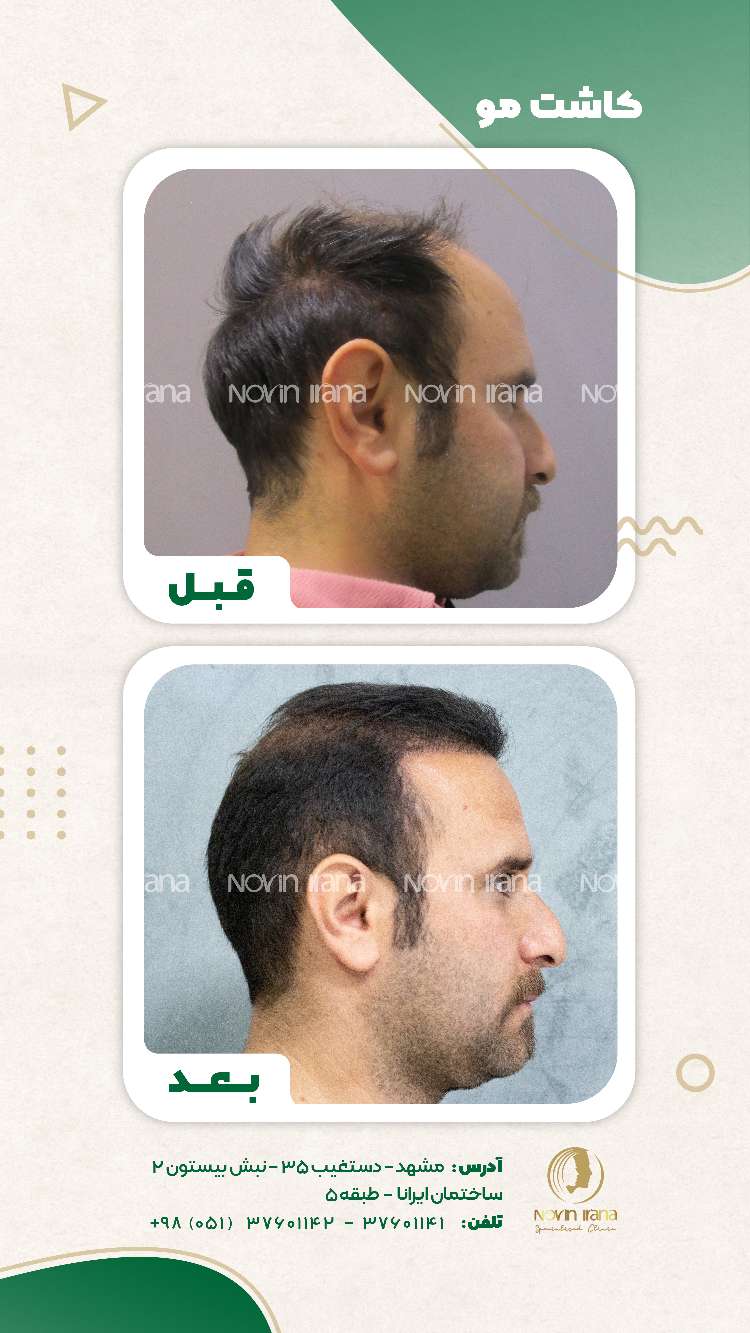 نمونه کاشت مو