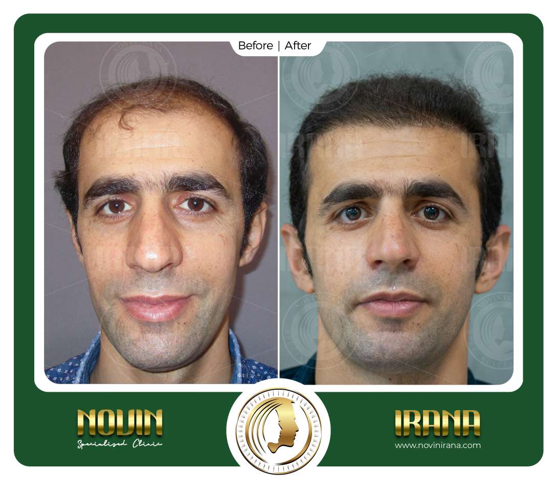 نمونه کاشت مو