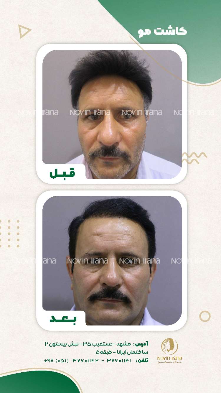 نمونه کاشت مو