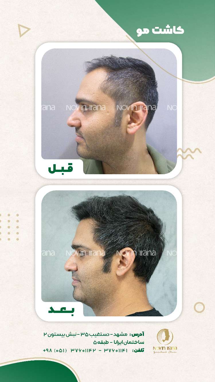 نمونه کاشت مو