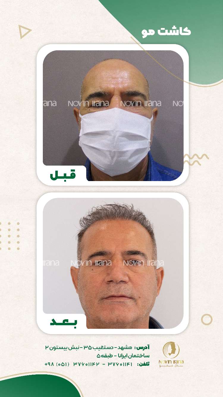 نمونه کاشت مو