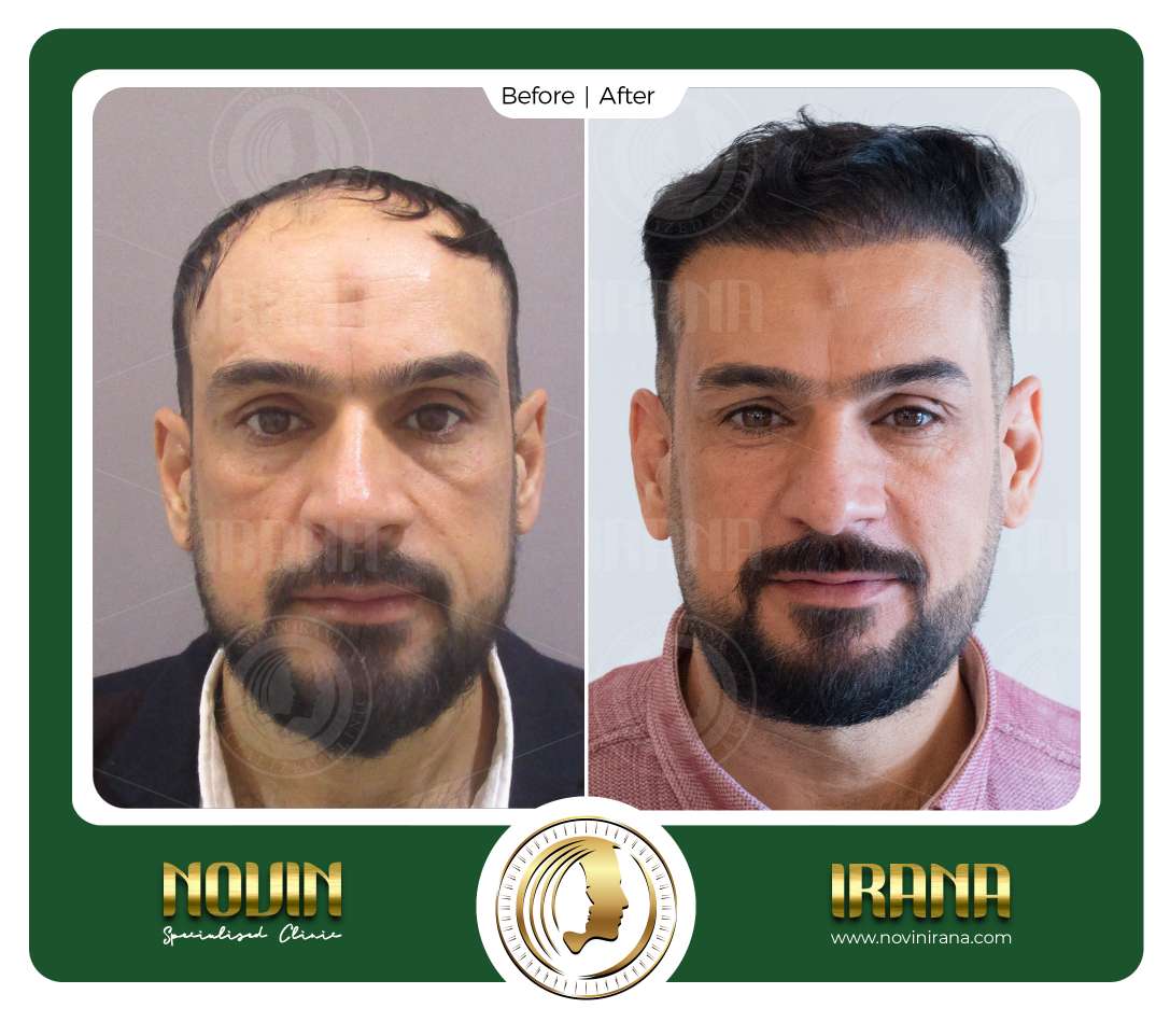 نمونه کاشت مو