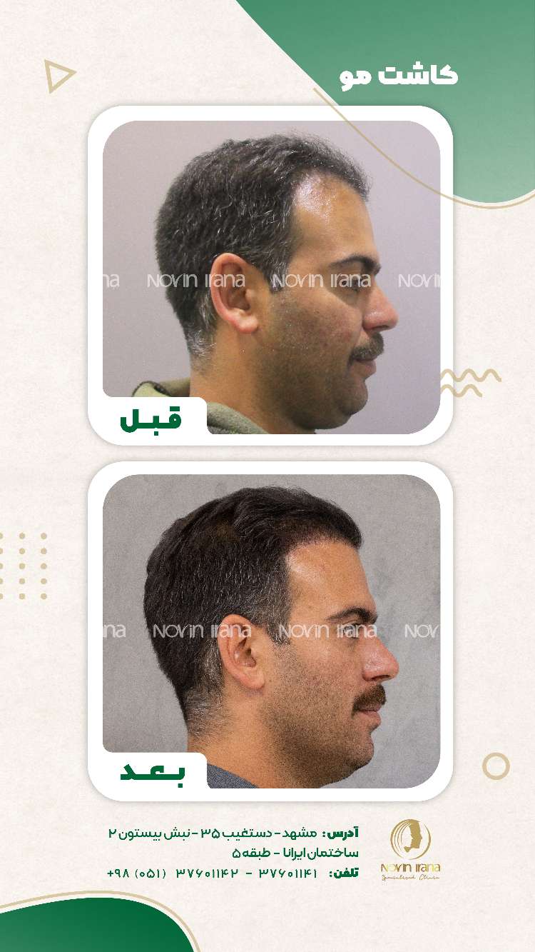 نمونه کاشت مو