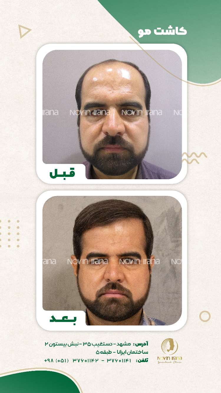نمونه کاشت مو