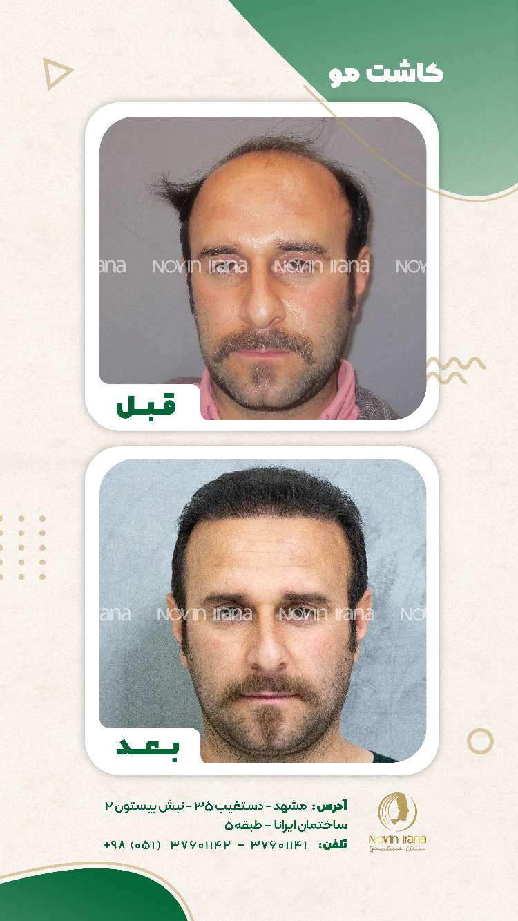 نمونه کاشت مو