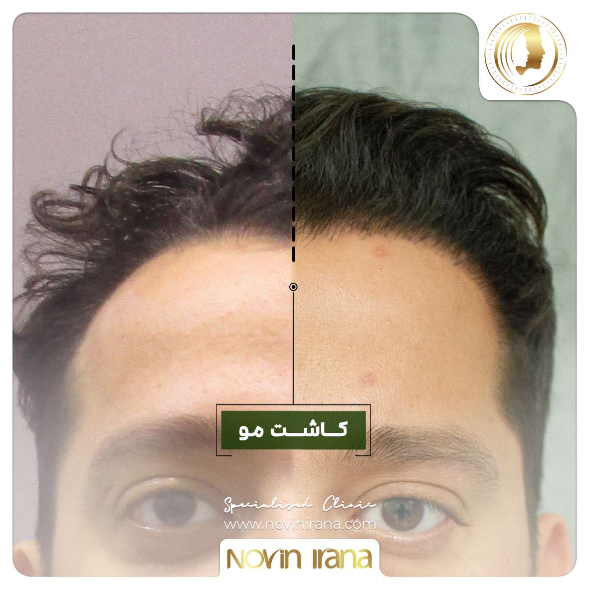 نمونه کاشت مو