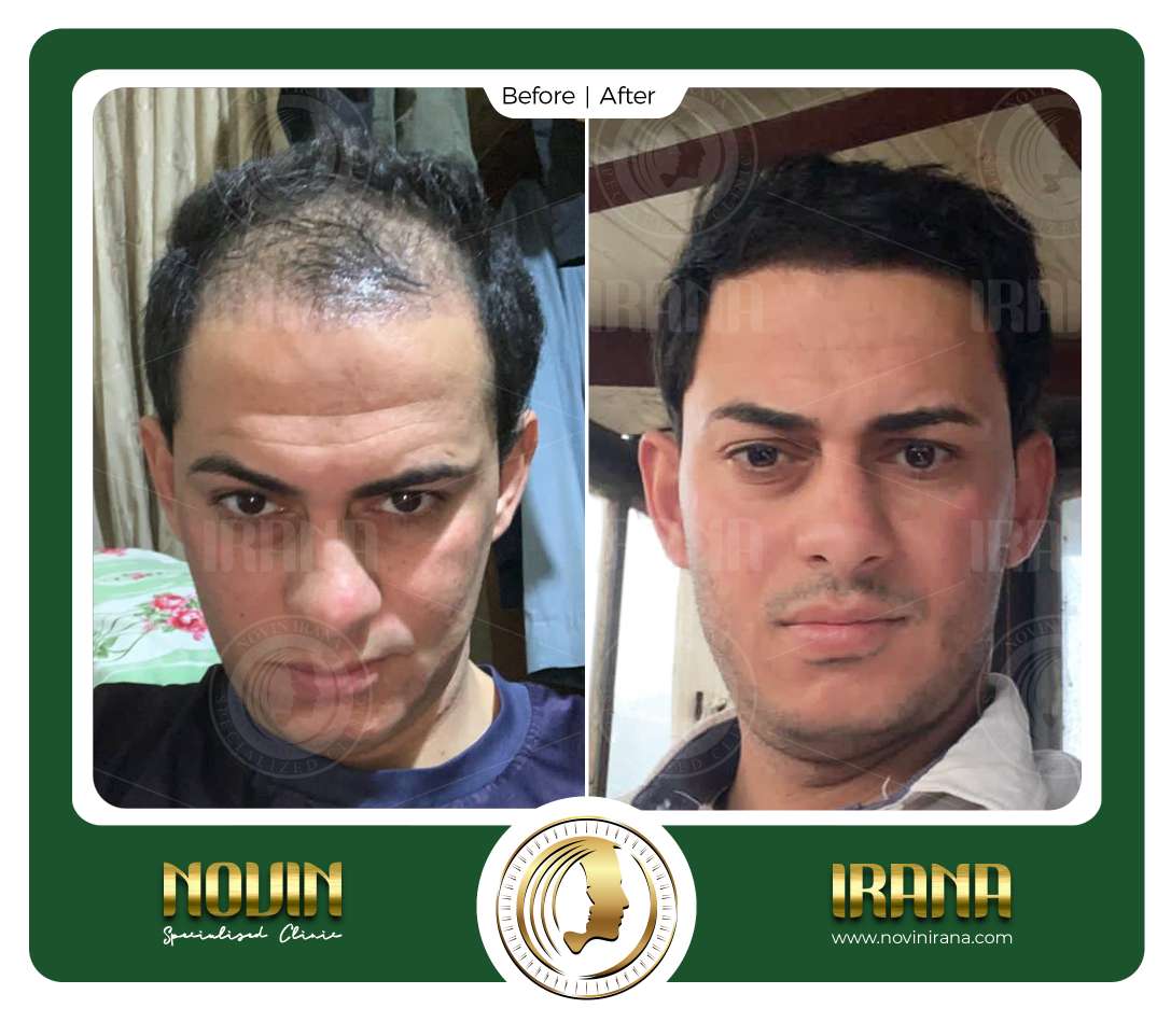 نمونه کاشت مو