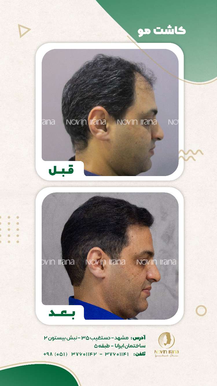 نمونه کاشت مو