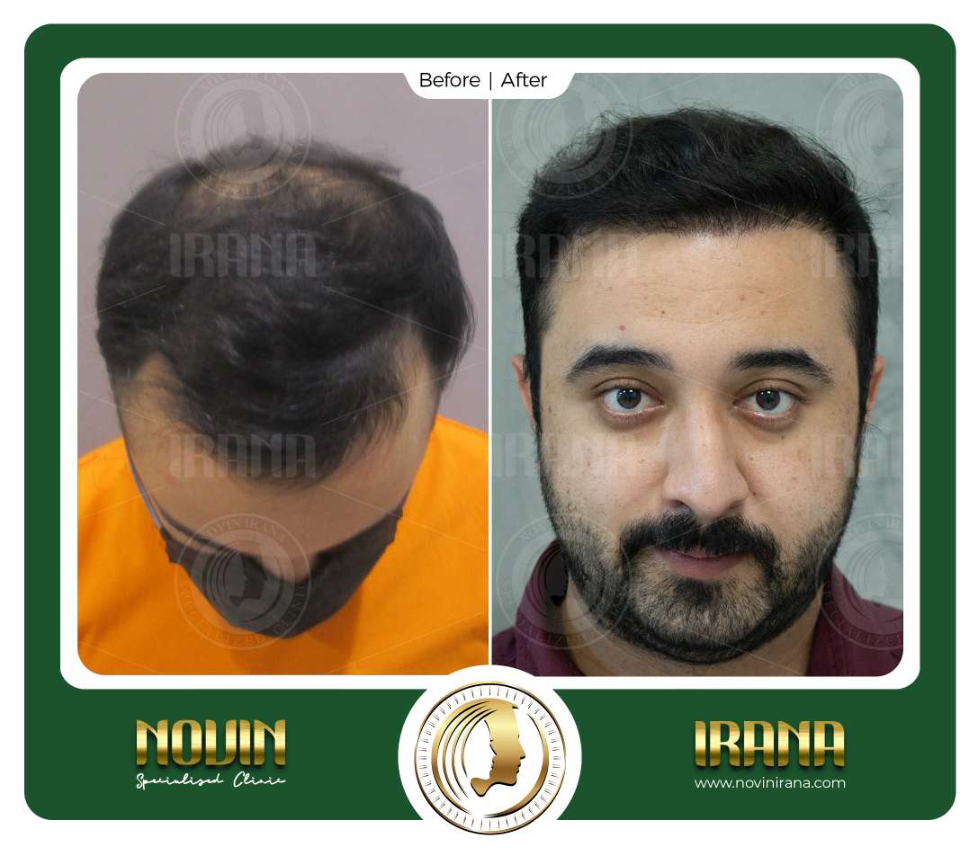 نمونه کاشت مو
