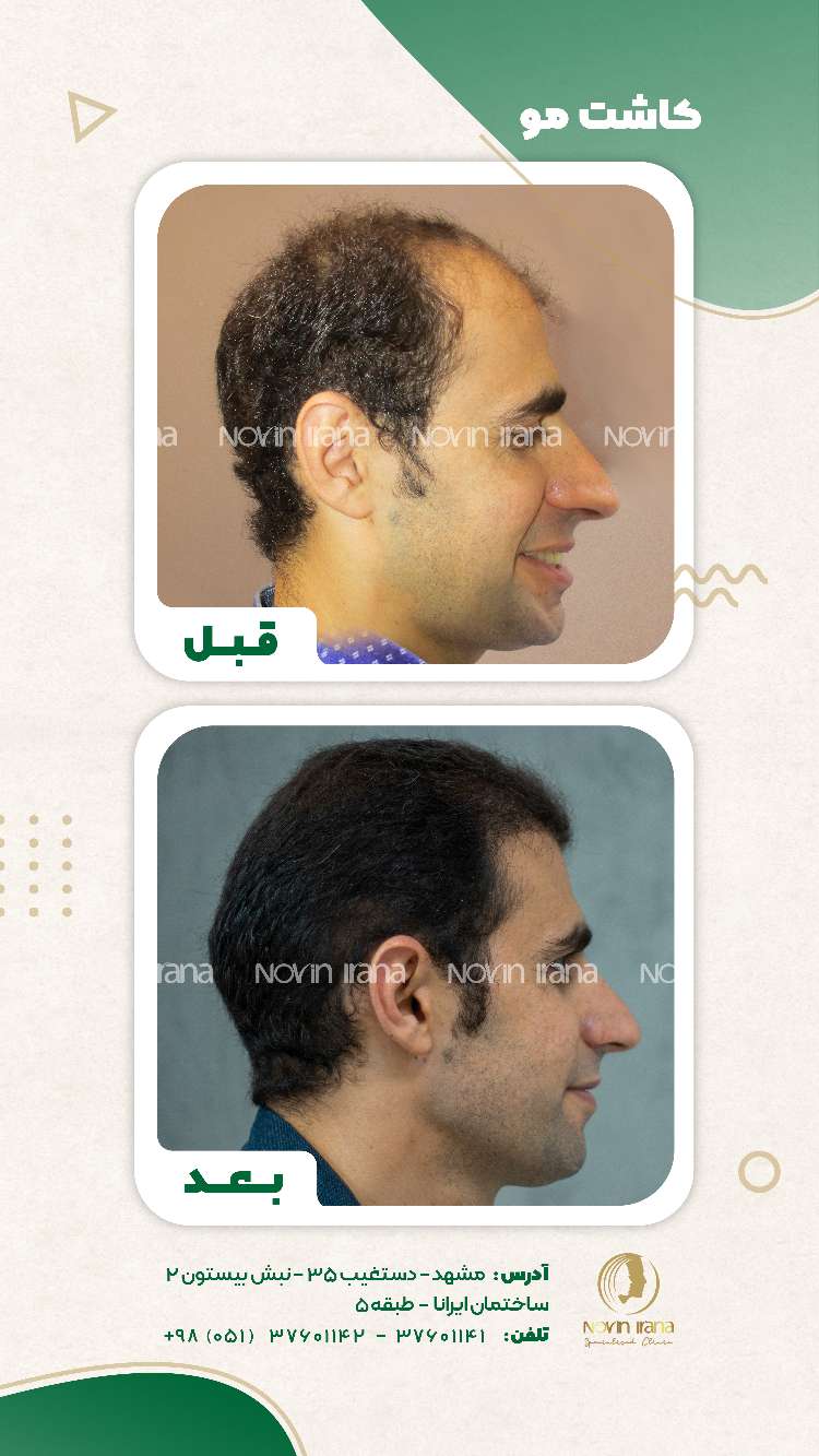 نمونه کاشت مو