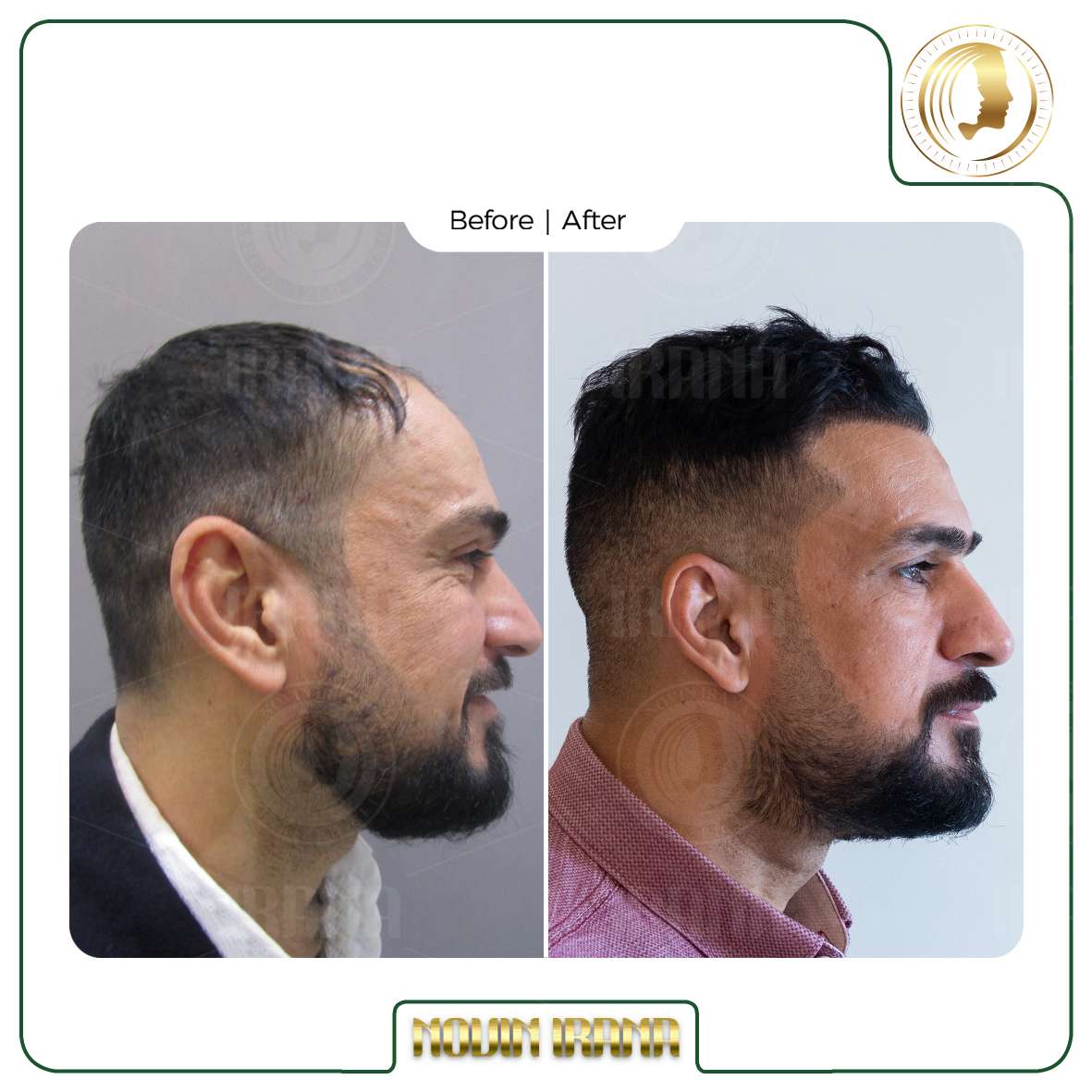 نمونه کاشت مو