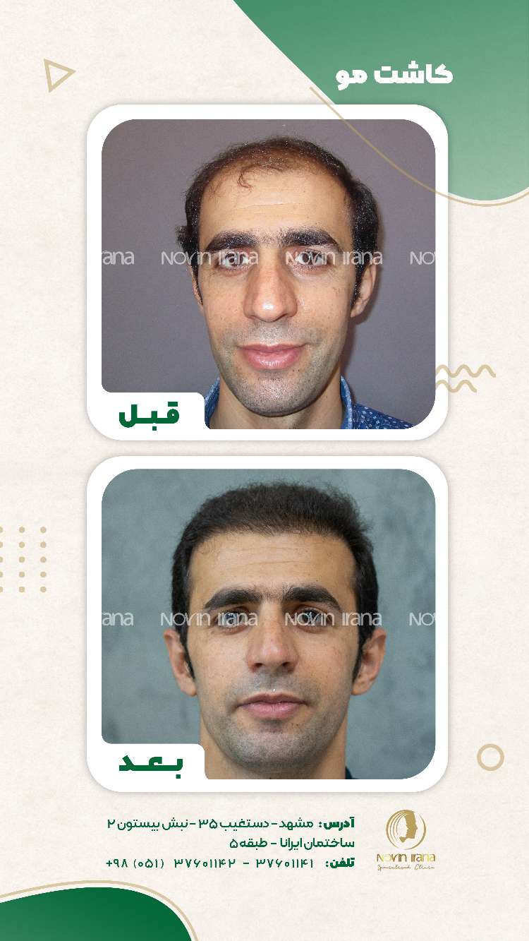 نمونه کاشت مو
