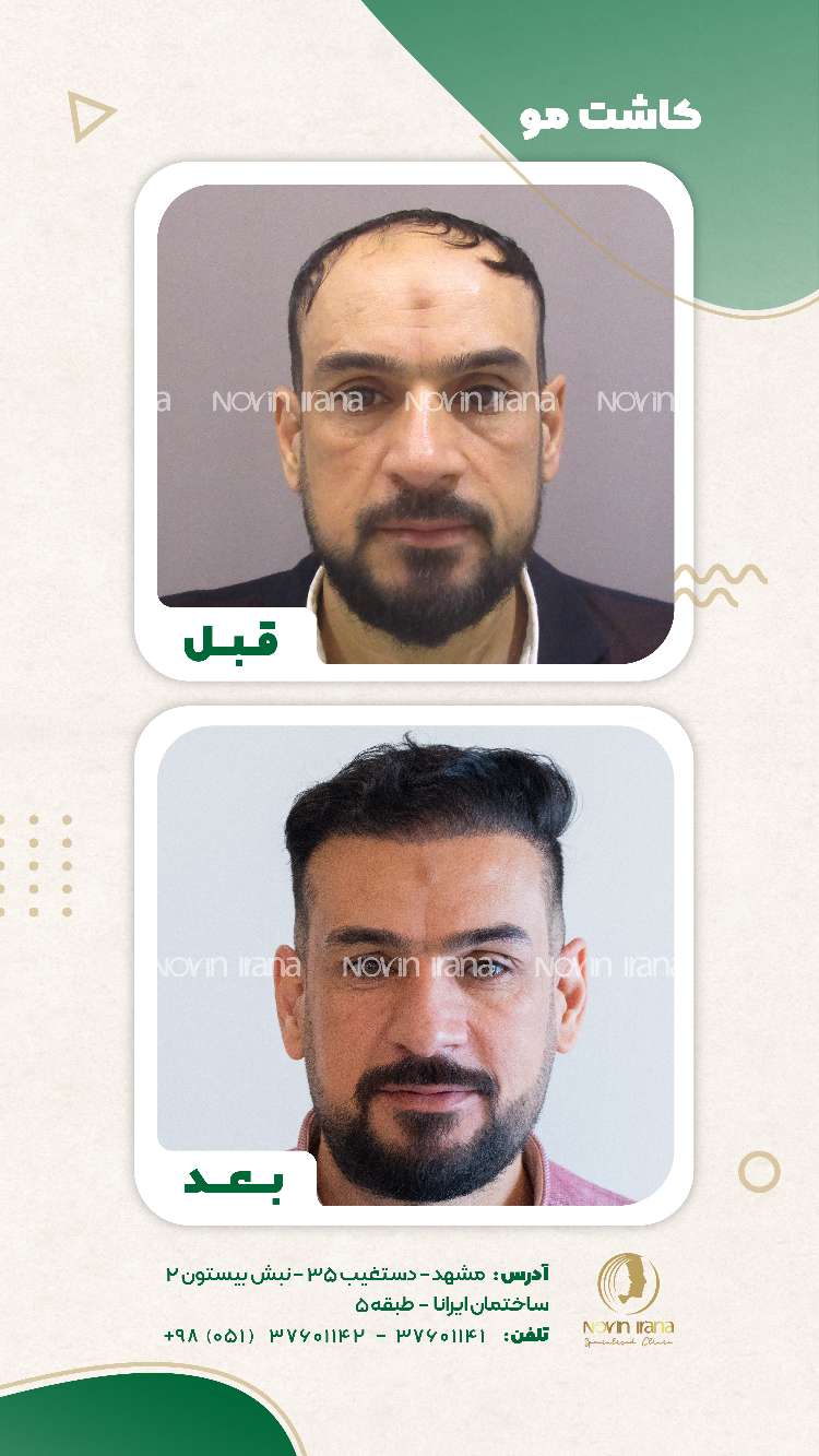نمونه کاشت مو