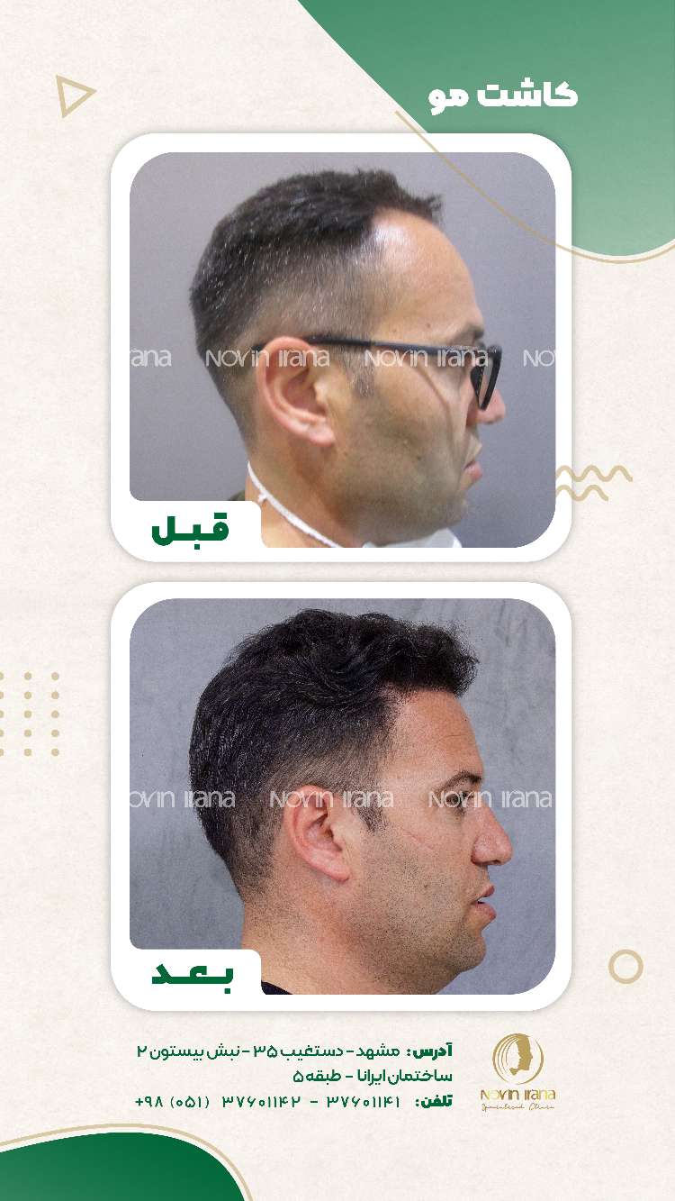 نمونه کاشت مو