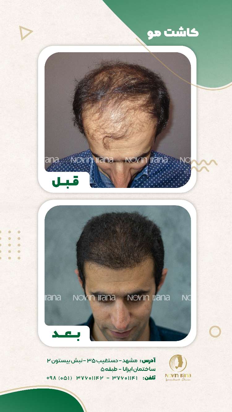 نمونه کاشت مو