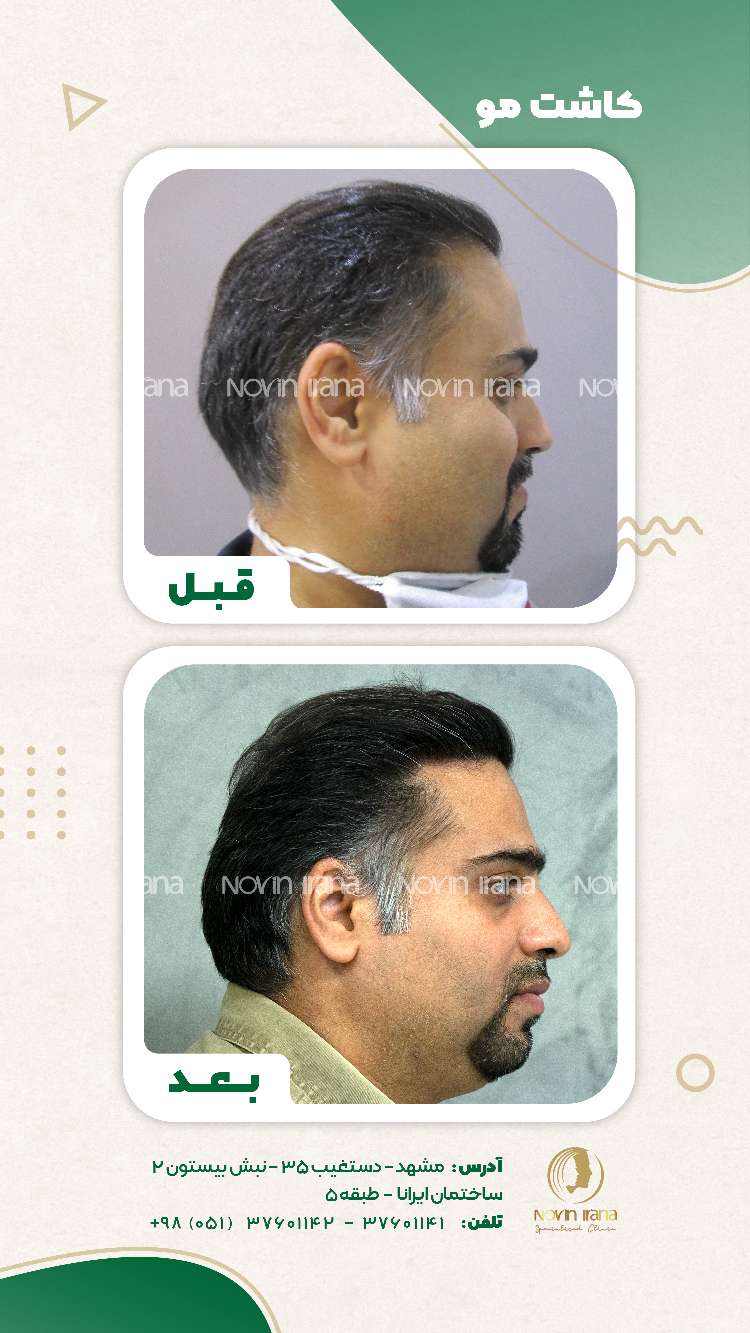 نمونه کاشت مو