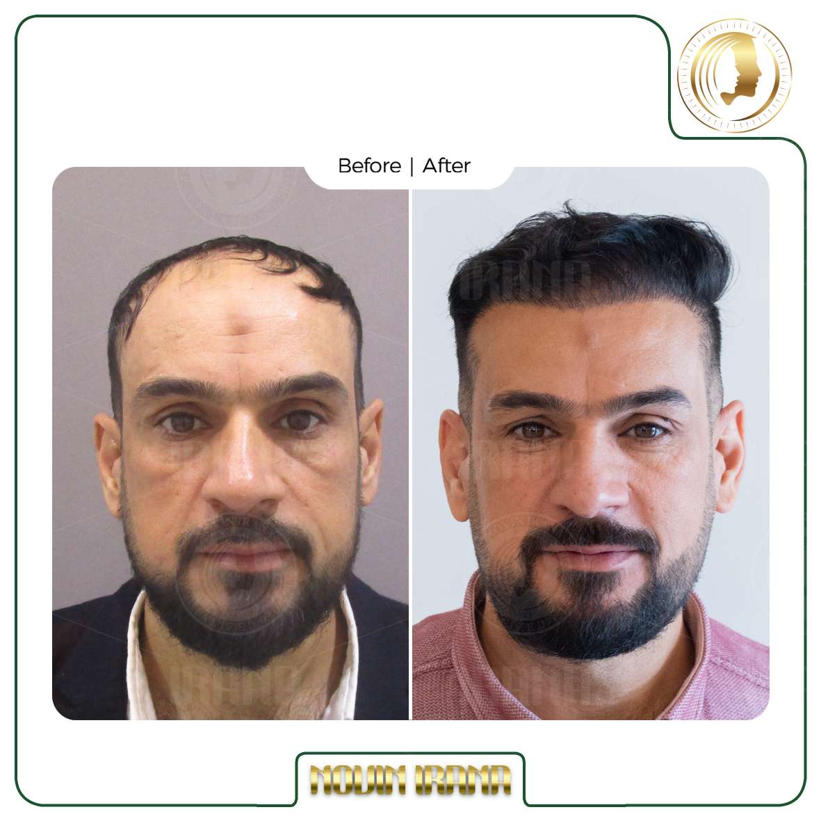 نمونه کاشت مو