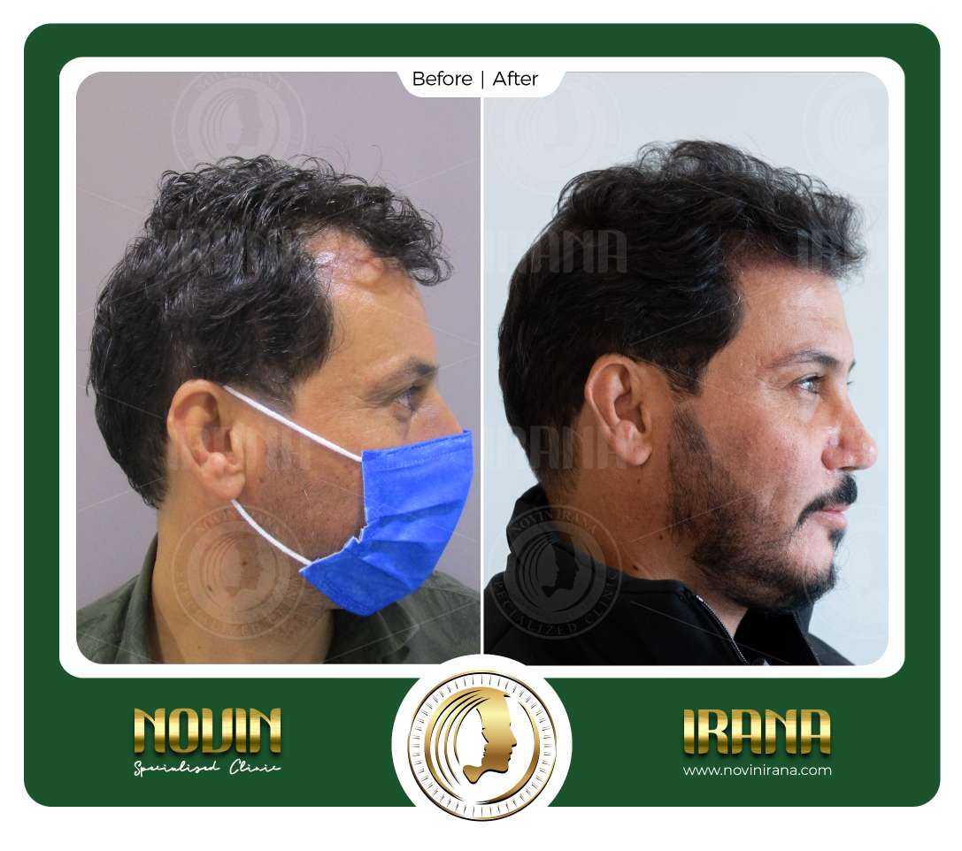 نمونه کاشت مو