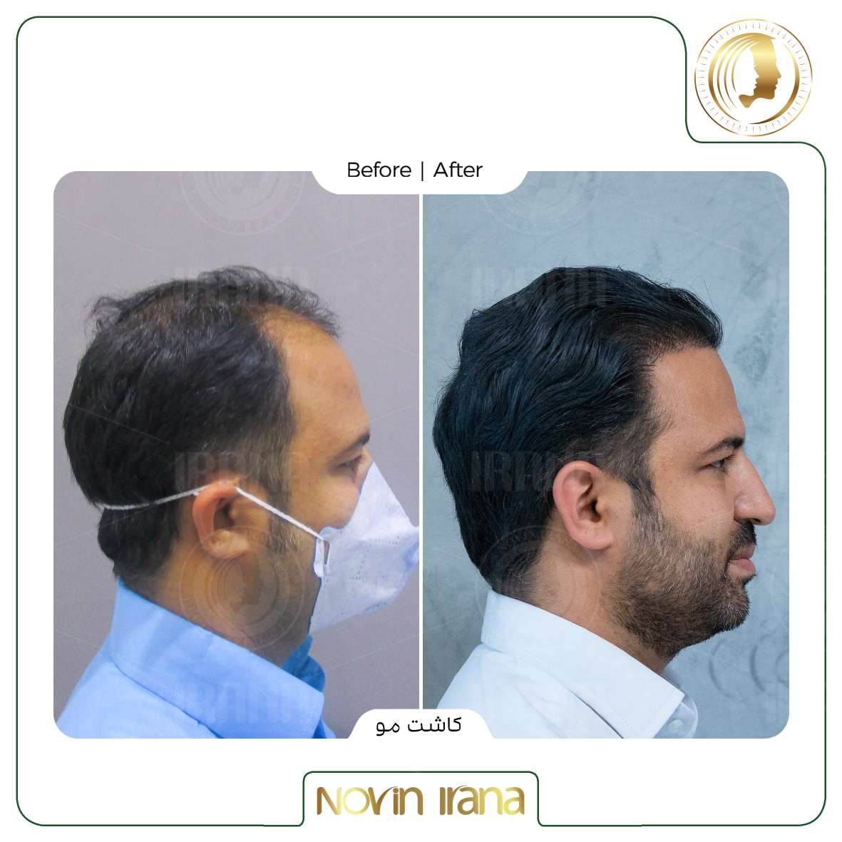 نمونه کاشت مو
