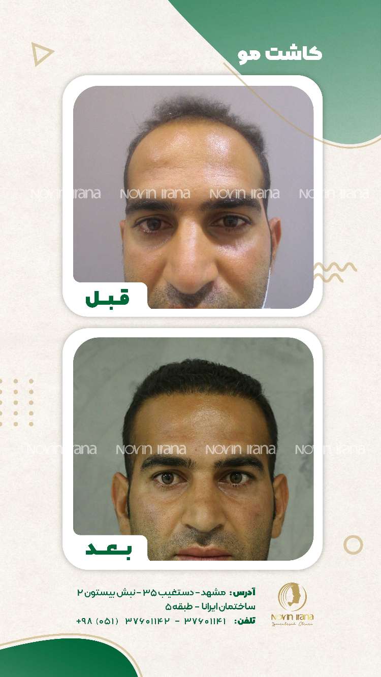 نمونه کاشت مو