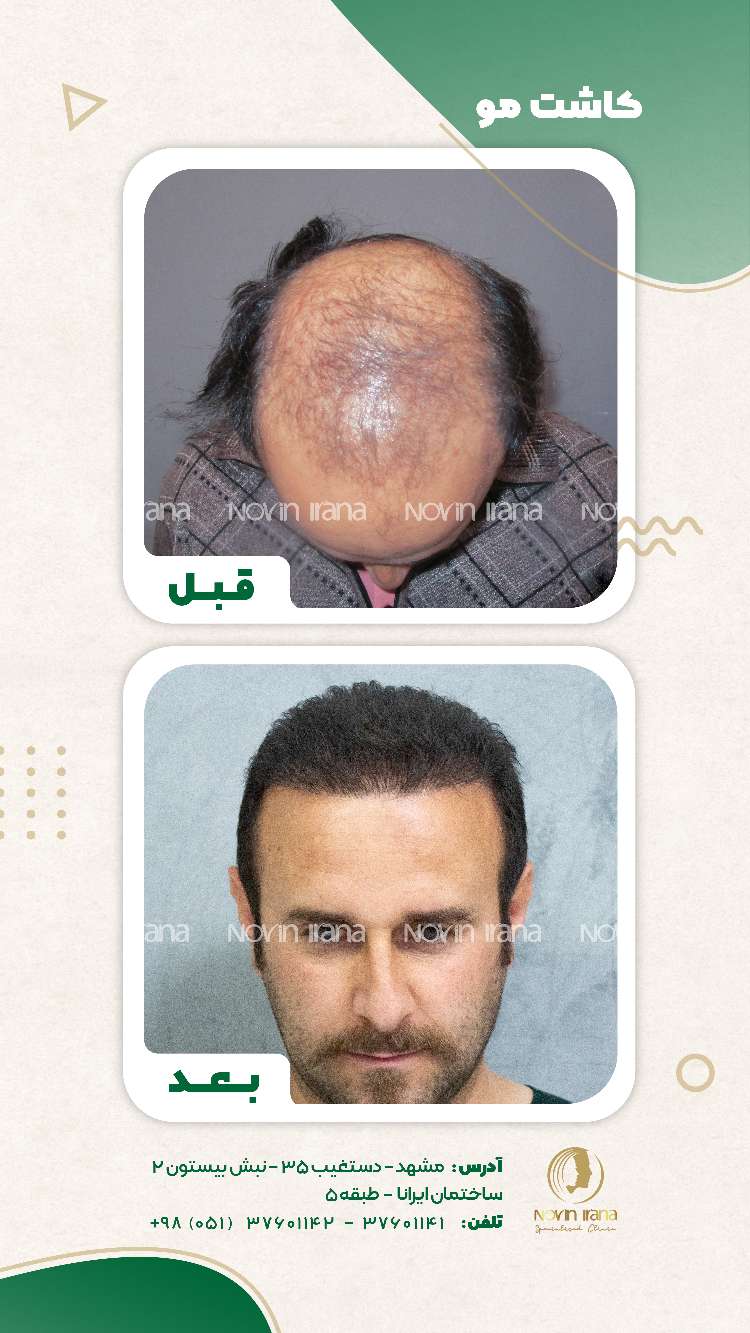 نمونه کاشت مو