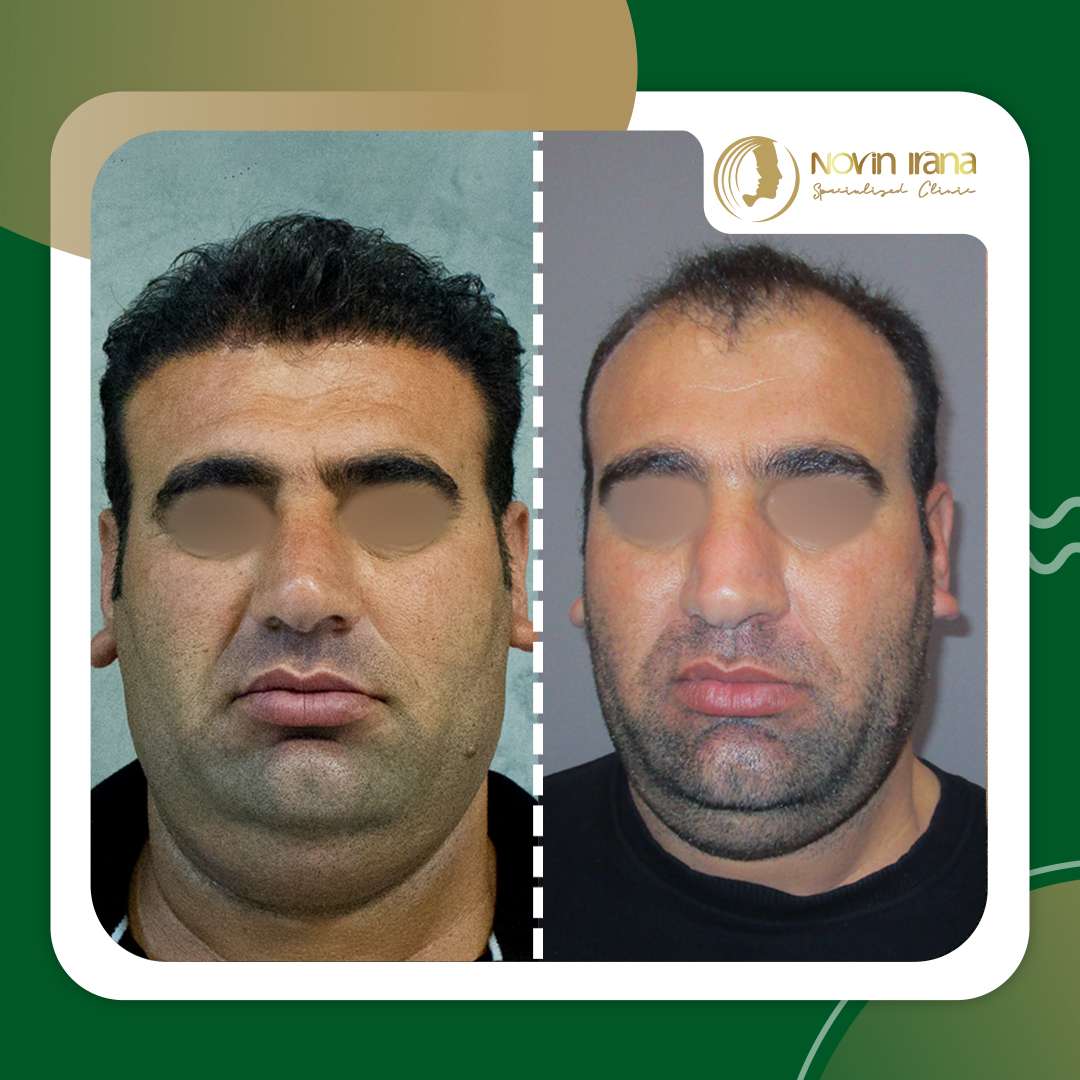 نمونه کاشت مو