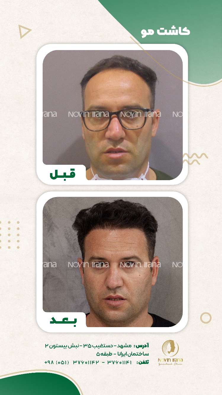 نمونه کاشت مو
