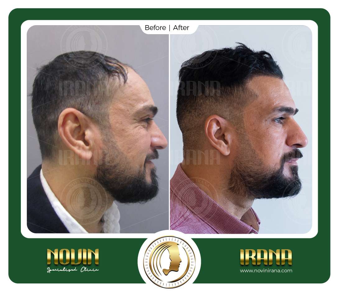 نمونه کاشت مو