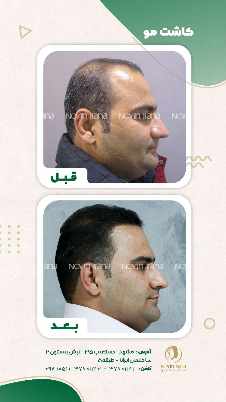 نمونه کاشت مو