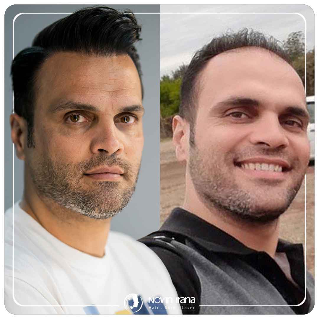 کاشت مو