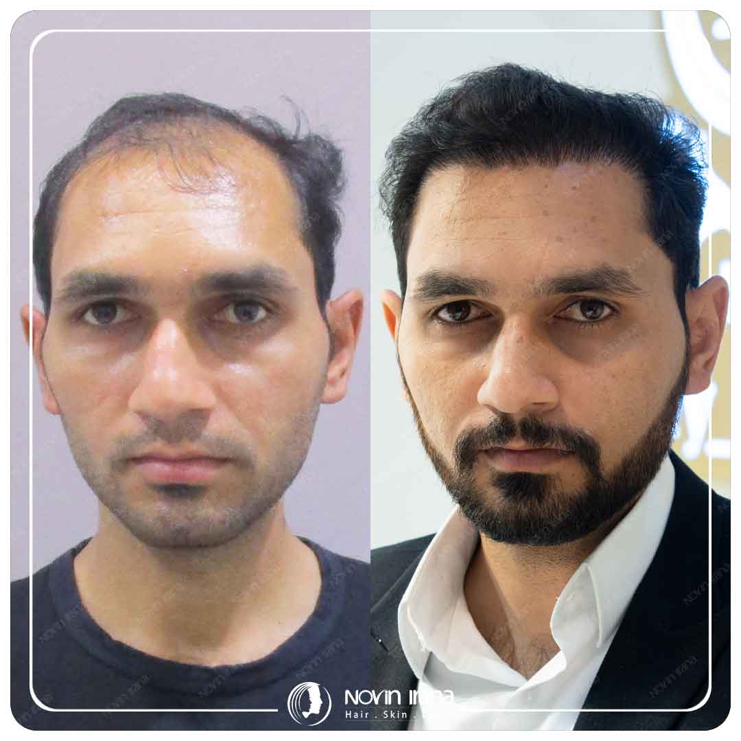 کاشت مو