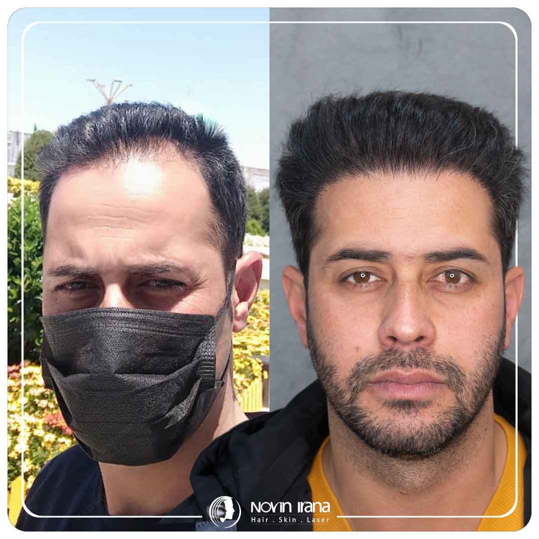 کاشت مو